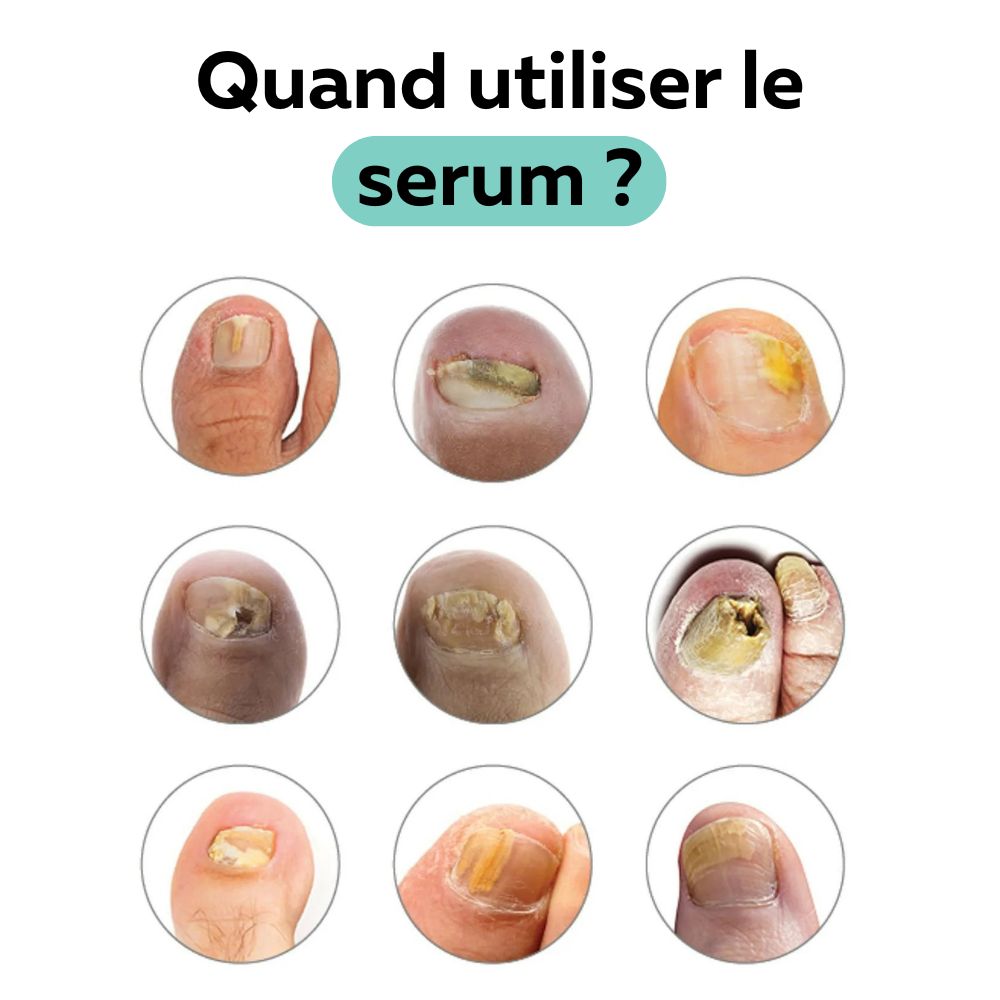 Sérum anti-mycose