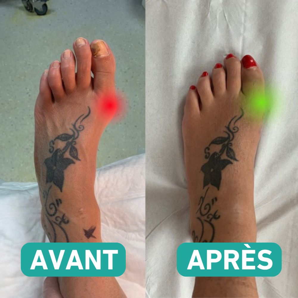 Chaussette correctrice Hallux valgus