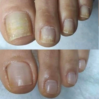 Collagen